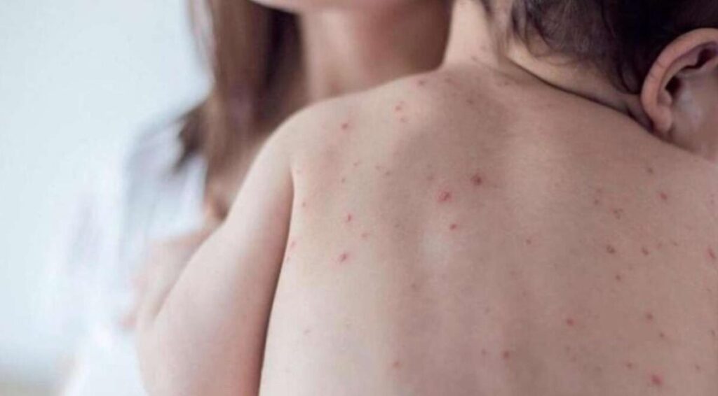 Morelos reporta un nuevo caso de sarampión en una bebé